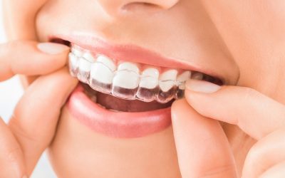 Ortodoncia Invisible en el Barrio del Pilar de Madrid: Todo lo que debes saber